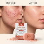 Himalayan Salt Soap | Tea Tree Oil Extract | Anti-Acne | Chemical Free - 90g